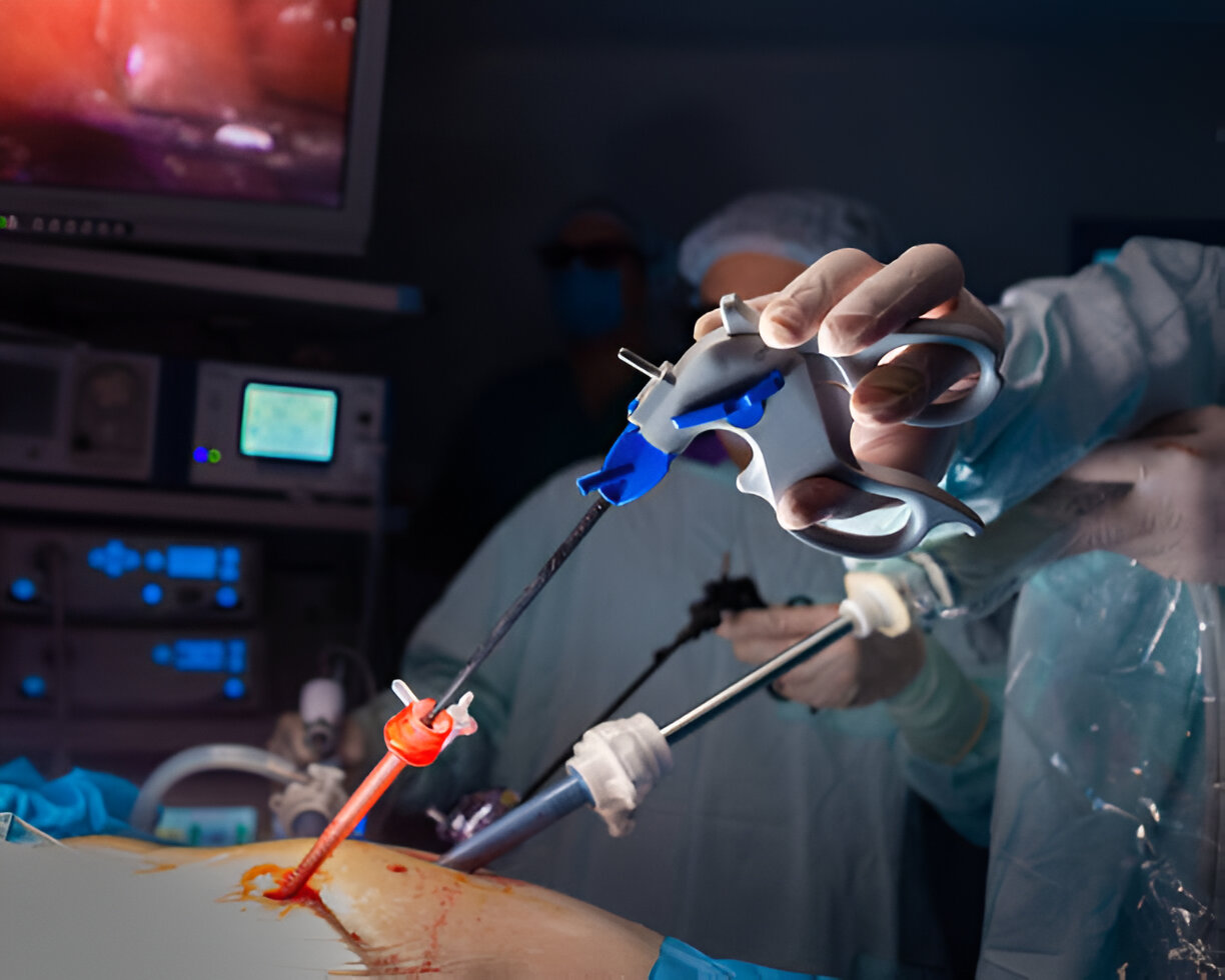 Laparoscopic Cholecystectomy