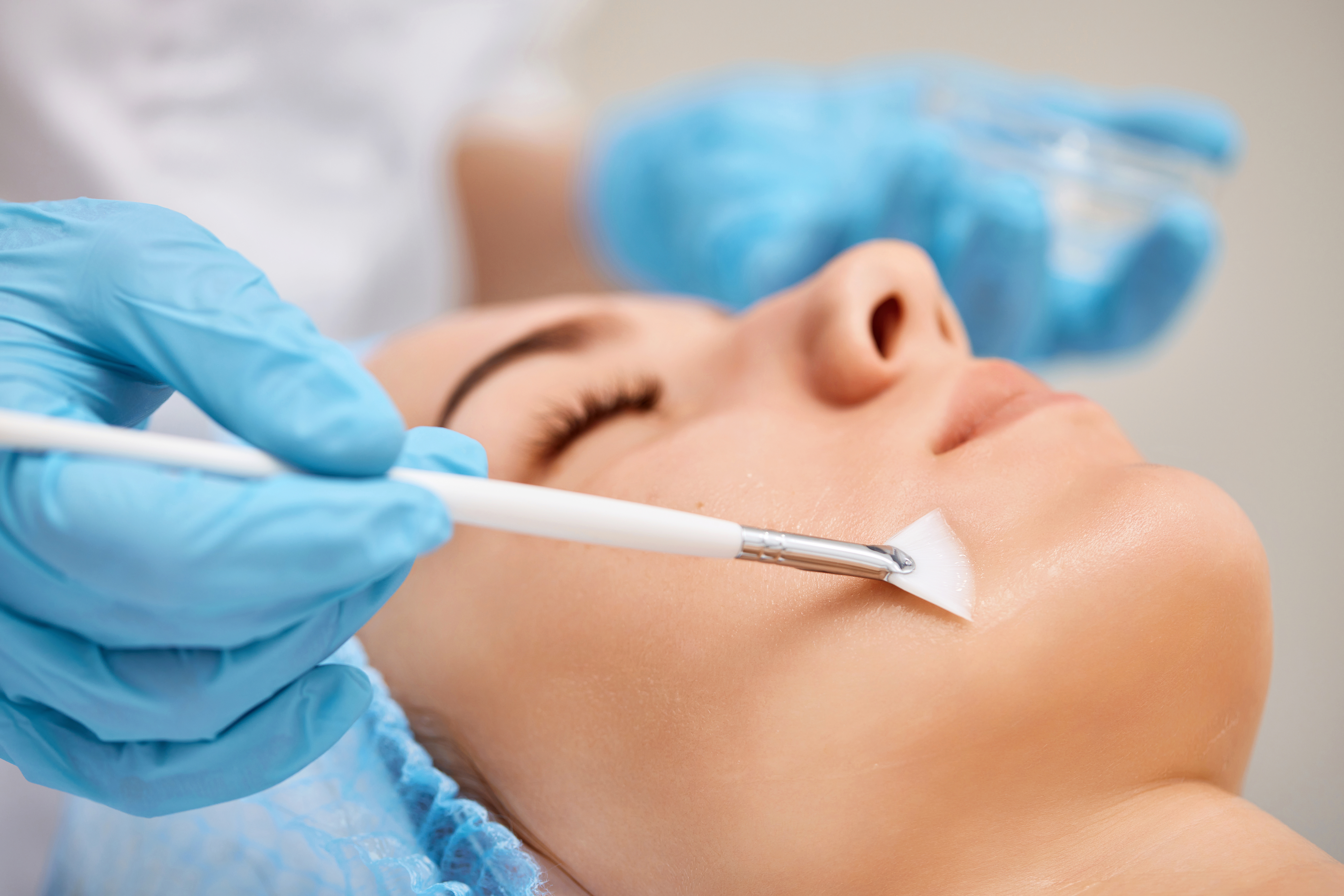 Chemical Peels
