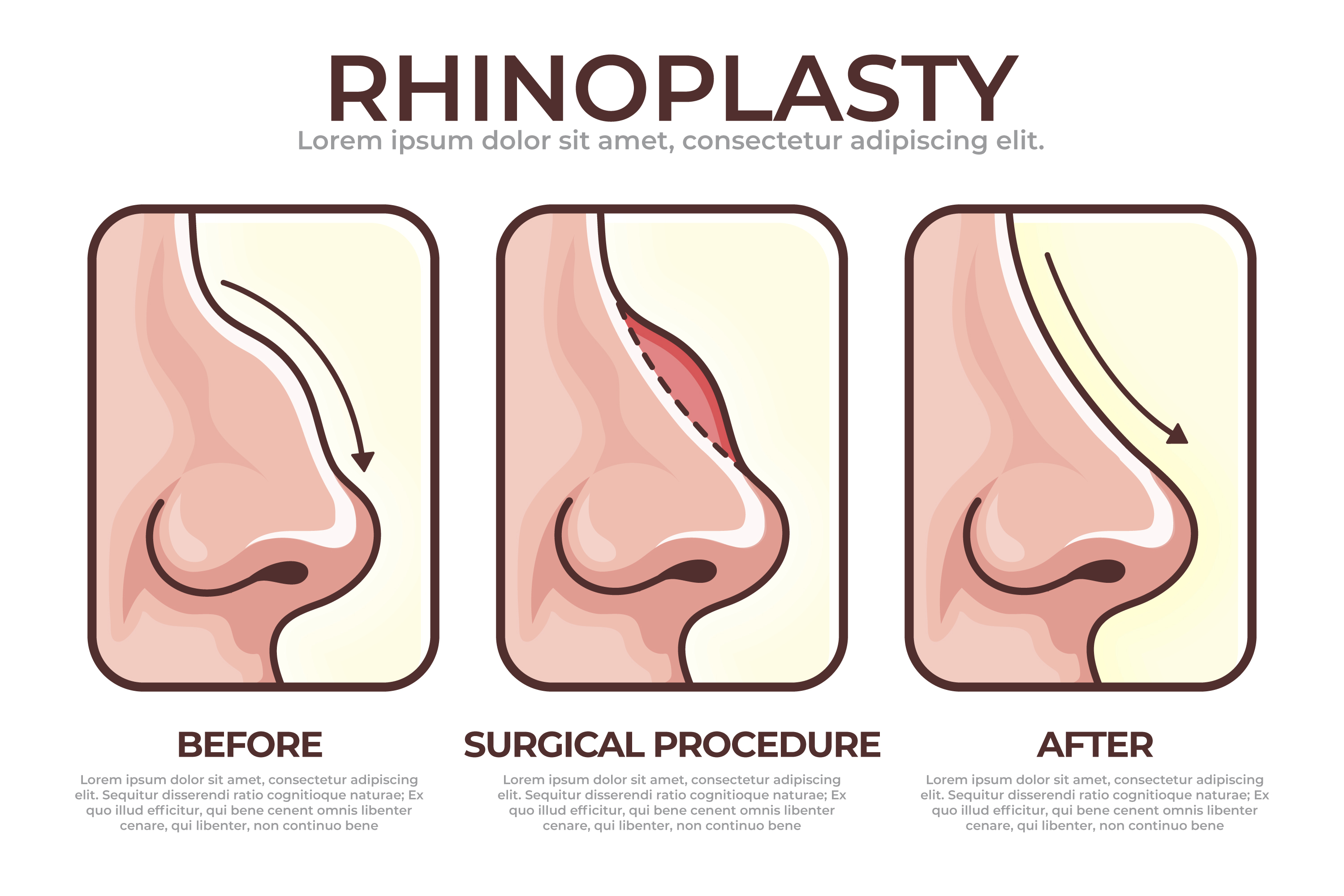 Rhinoplasty Surgery